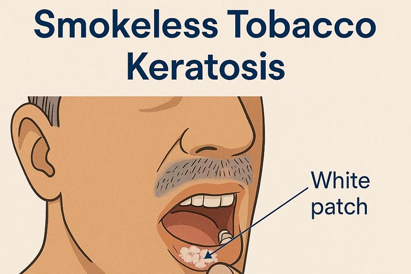 smokeless tobacco keratosis treatment Oral pathology minute! affects 15% of chewing tobacco users and 60% of snuff users It usually takes between 1 and 5 years to develop Lesion Smokeless Tobacco Risks for Teeth